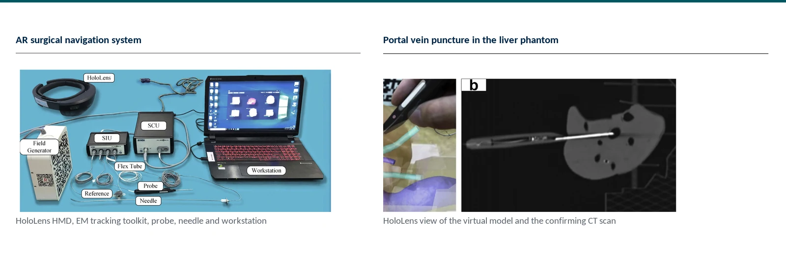 Graphical abstract of CT-based vessel modeling, electromagnetic tracking, and augmented-reality guidance for TIPS puncture