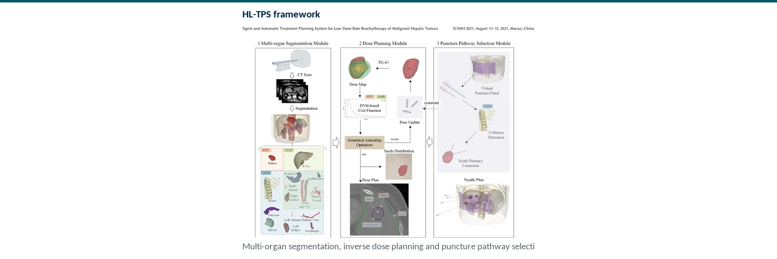 Graphical abstract of automatic hepatic brachytherapy planning with organ segmentation, parameterized seeds, inverse dose optimization, and safe puncture paths