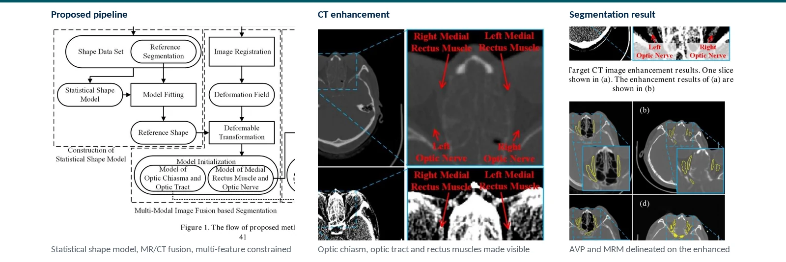 Graphical abstract of CT-MR fusion, statistical shape transfer, and feature-constrained fitting for AVP and medial rectus muscle segmentation