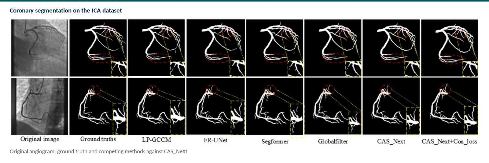 Graphical abstract of CAS_Next using dynamic deformable convolution, global frequency filtering, and connectivity loss for topology-preserving coronary segmentation