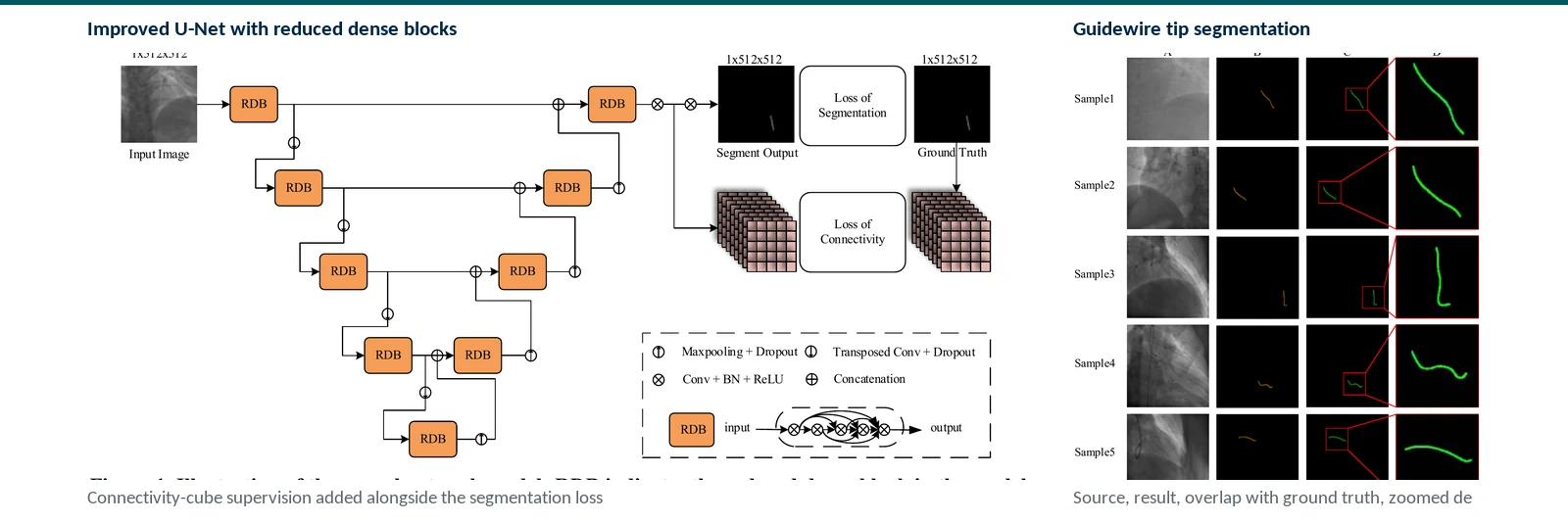 Graphical abstract of guidewire-tip segmentation using an improved U-Net with dense blocks and connectivity supervision