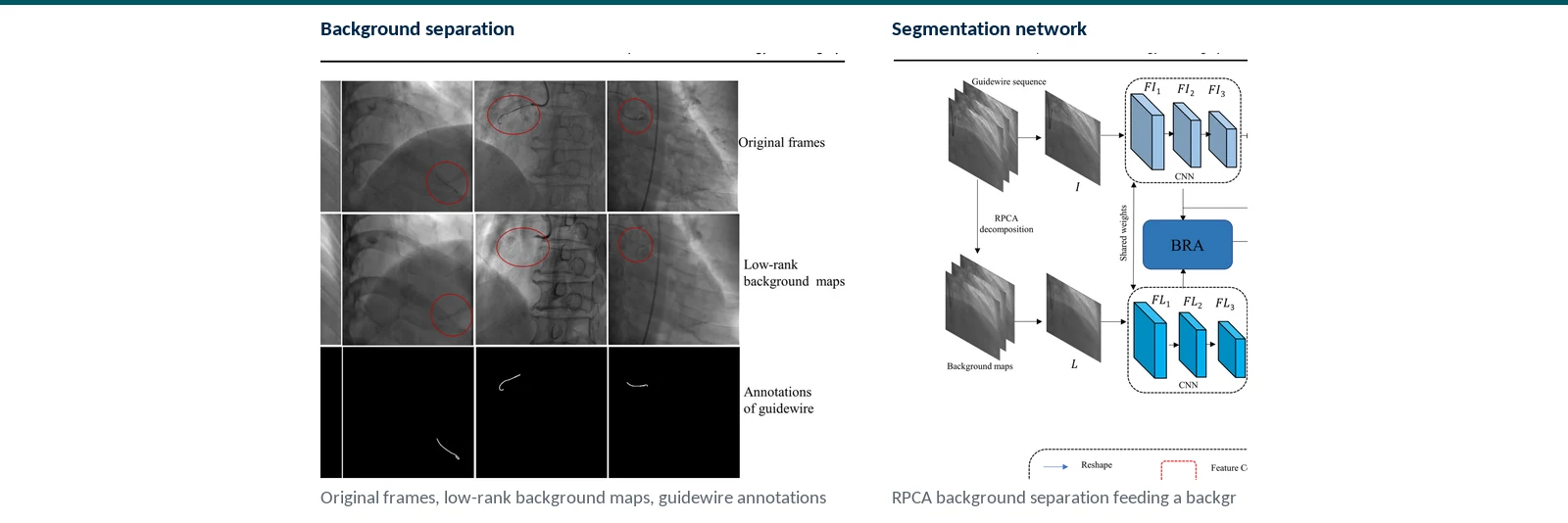Graphical abstract of jigsaw training, RPCA background modeling, and reverse-attention transformer segmentation for single and dual guidewires
