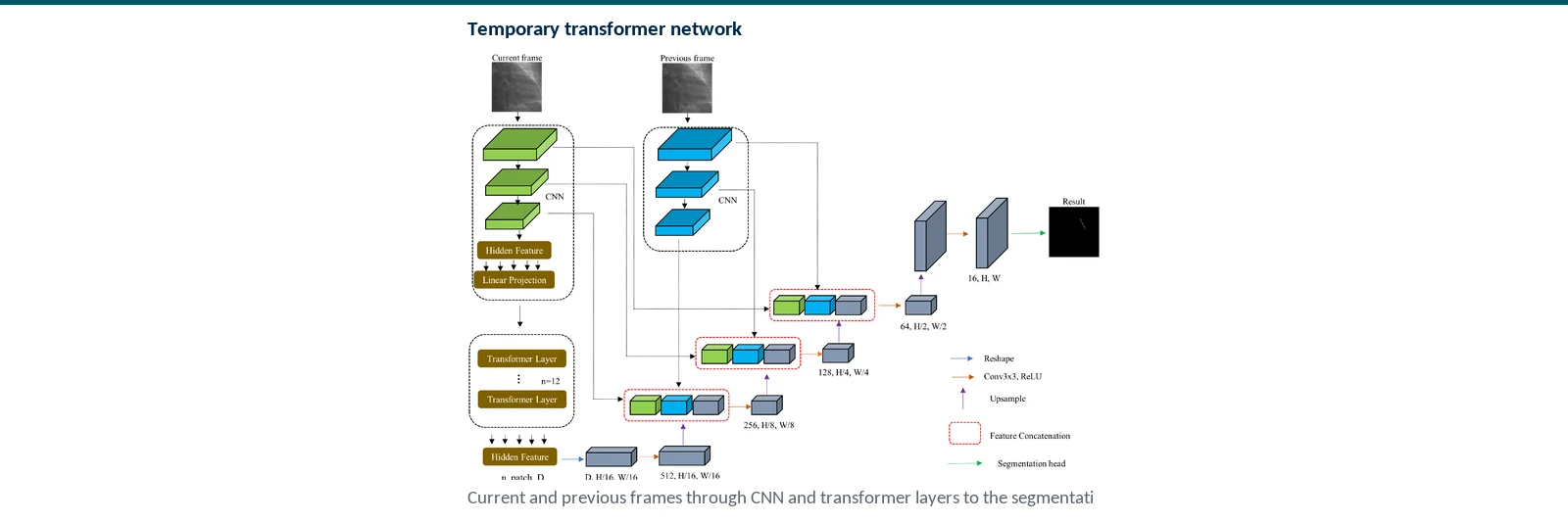 Graphical abstract of a temporal transformer combining previous and current fluoroscopy frames for guidewire segmentation